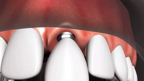 Dental Implant Dentagama
