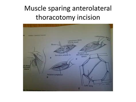Ppt Thoracic Incisions Powerpoint Presentation Id391276