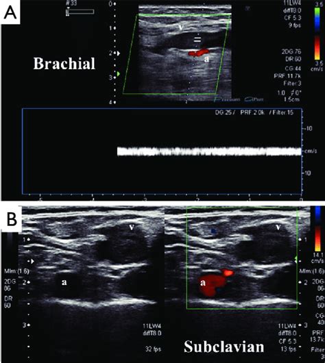 Compression Ultrasonography Showing An Acute Deep Vein Thrombosis Dvt