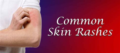 Skin Rashes Types Causes Diagnosis Treatment Skin Care Medplusmart