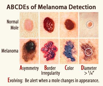 What does a normal mole look like. Identifying Skin Cancer | Samaritan Health Services