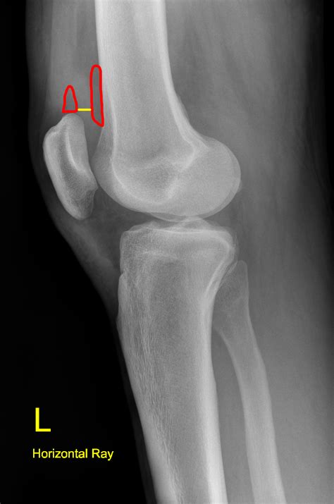 Knee X Ray Interpretation Dont Forget The Bubbles