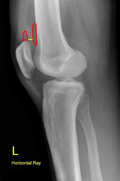 Knee X Rays Dont Forget The Bubbles