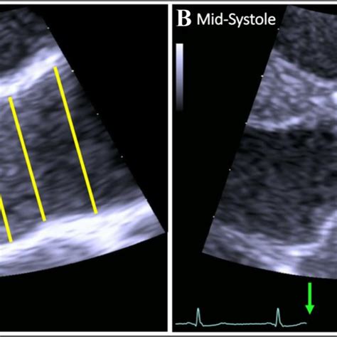 Echocardiographic Measurements Of The Aortic Root In End Diastole A