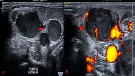 Cureus Evaluation Of B Mode And Color Doppler Ultrasound In The