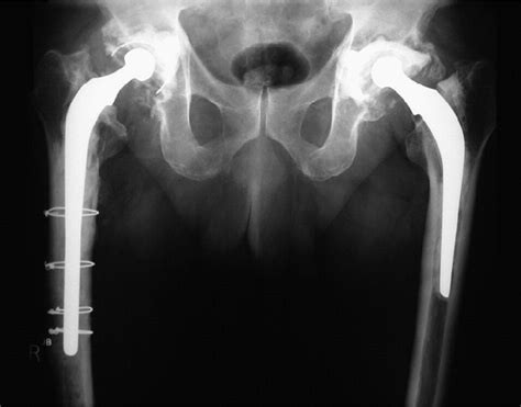 Thirty Year Results Of A Prospective Study Of Charnley Total Hip