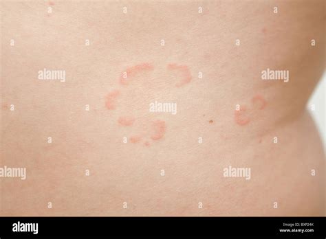 Mild Psoriasis On Skin On Side Of Abdomen Stock Photo Alamy