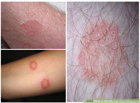 Details More Than 69 Ring Rash On Skin Vn