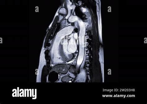 Mri Heart Or Cardiac Mri Magnetic Resonance Imaging Of Heart In Rvot