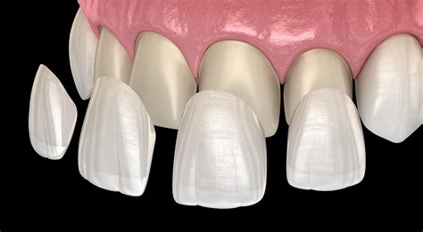 Dental Veneers Types Uses And Process Safar Medical
