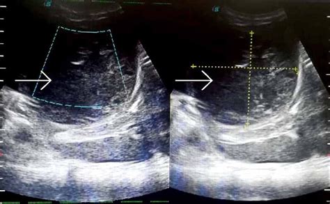 Cureus Pericardial Effusion Secondary To Amoebic Liver Abscess A