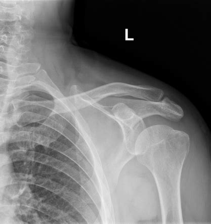 Humeral Greater Tuberosity Fracture Radiology Case Radiopaedia Org