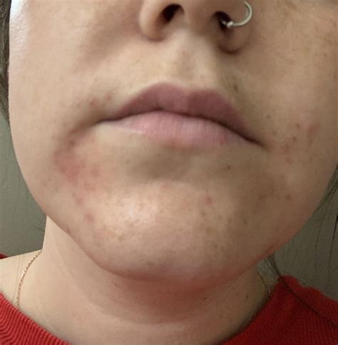 The reasons why you get pimples around mouth depend on a number of different factors. Skin Concerns Acne around my mouth, any tips ...