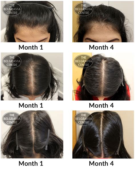Success Story Alert New Female Pattern Hair Loss Treatment Entry