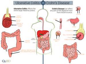 Differences Between Crohn S And Colitis Qu Ibd