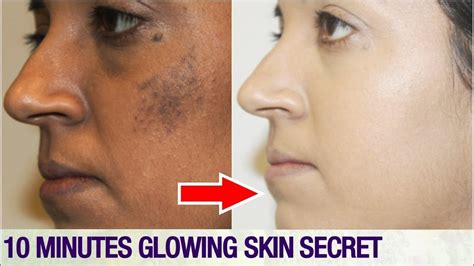 Syawa Nigma Pigmentation Removal Before And After