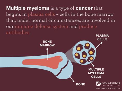 Multiple Myeloma Signs And Symptoms Dana Farber Cancer Institute