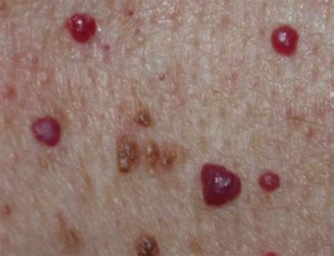 Brown Spots On Face Skin Causes Raised Patches Pictures Get Rid