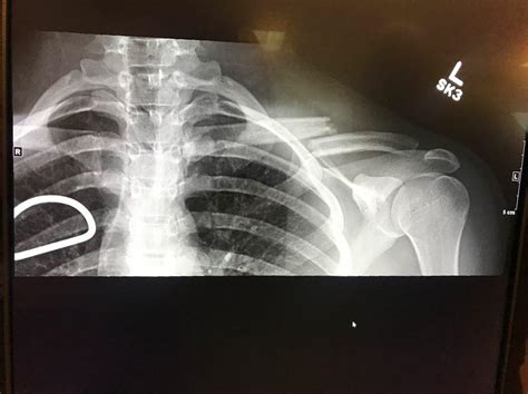 Friend Tripped Going To His Bus For School And Broke His Collar Bone