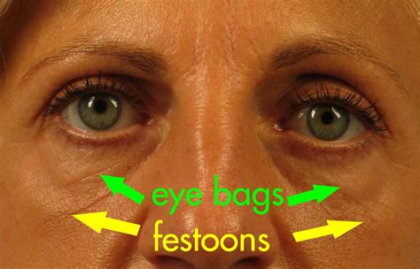 What Are Festoons Dr Brett Kotlus Cosmetic Oculoplastic Surgeon Nyc
