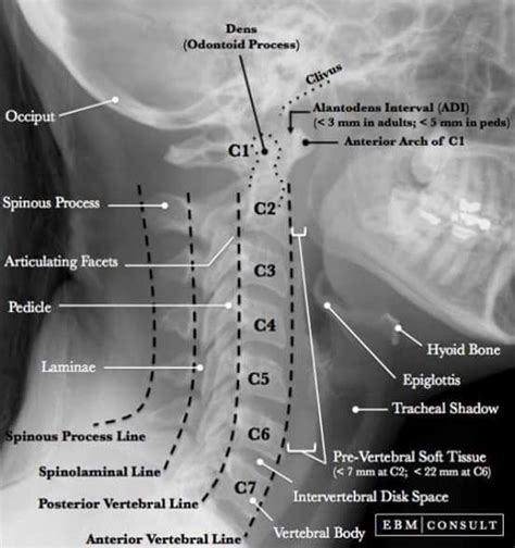Estructuras En Una Radiografía Lateral De Cabeza Y Cuello Radiology