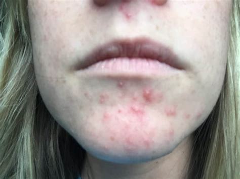 Perioral Dematitis Products And Treatments That Helped My Skin Quickly