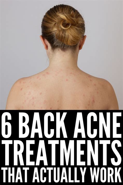 List Of How To Get Rid Of Shoulder Acne Quick