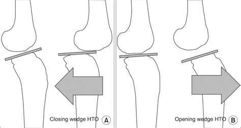 Change Of The Tibial Slope After High Tibial Osteotomy A Closing