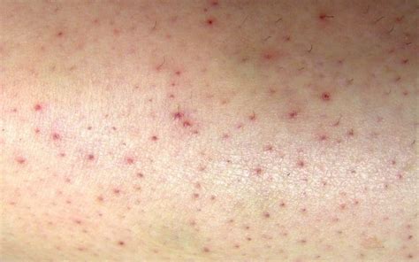 Petechiae Symptoms Causes Treatment And Prevention