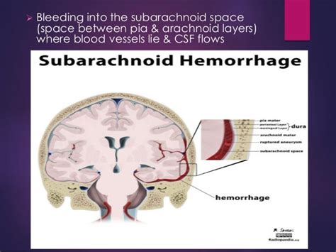 Sah Subarachnoid Haemorrhage