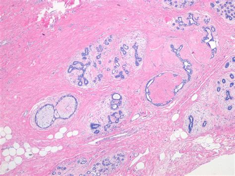 Pathology Outlines Fibroadenomatoid Change