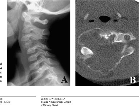 Figure 1 From Aneurysmal Bone Cyst Of The Cervical Spine Semantic Scholar