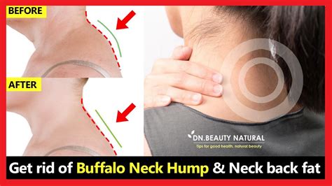 Work 100 How To Get Rid Of Neck Hump Fix Buffalo Neck Hump Fix