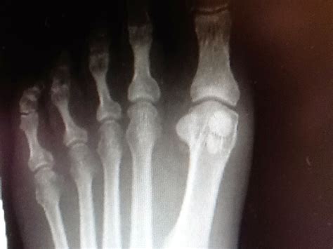 Foot And Ankle Problems By Dr Richard Blake Fractured Sesamoid Email