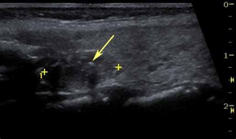 Ultrasounds are almost always used to evaluate thyroid nodules, and are also often used to examine lymph nodes in the surrounding area. RiT radiology: Features Suggestive of Malignant Thyroid ...