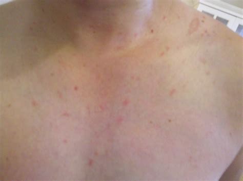 Hi I Have A Question About A Rash That Has Appeared All Over