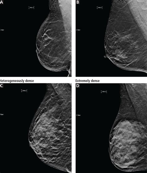Common Benign Breast Concerns For The Primary Care Physician
