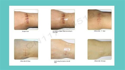 The end result is a smoother, flatter scar and skin with a more natural palor. 1Pc Silicone Sheet + 1Pc Scar Cream Fast Way To Remove ...