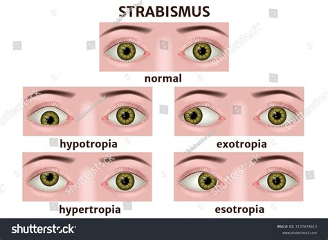 Varieties Of Strabismus Eye Disease Infographic Royalty Free Stock