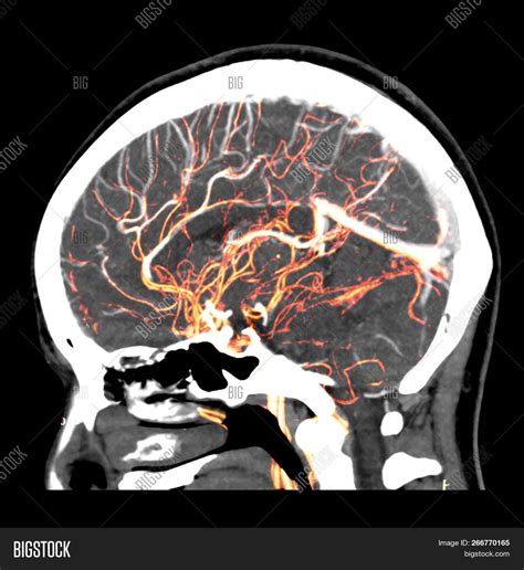 2d And 3d Rendering Image Of The Human Brain Showing Normal Arteries In