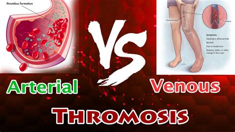 Arterial Thrombosis Vs Venous Thrombosis Clear Comparison Youtube