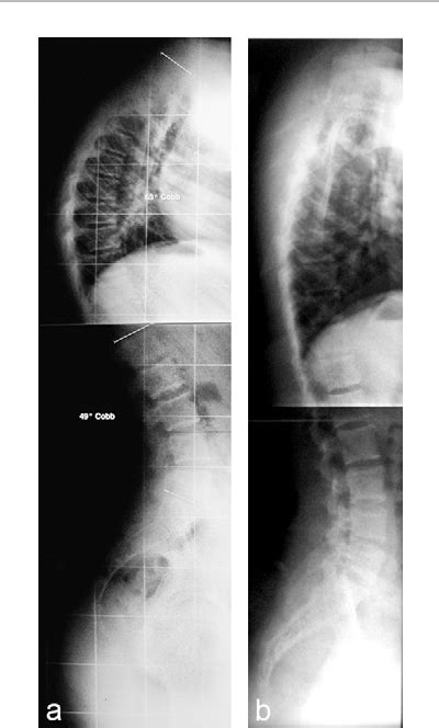 Figure 3 From Round And Angular Kyphosis In Paediatric Patients