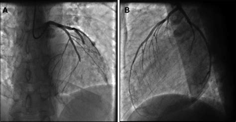 Coronary Embolism Among St Segmentelevation Myocardial Infarction