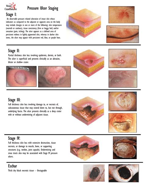 Stages Of Pressure Ulcers Pressure Ulcer Pressure Ulcer Staging Images