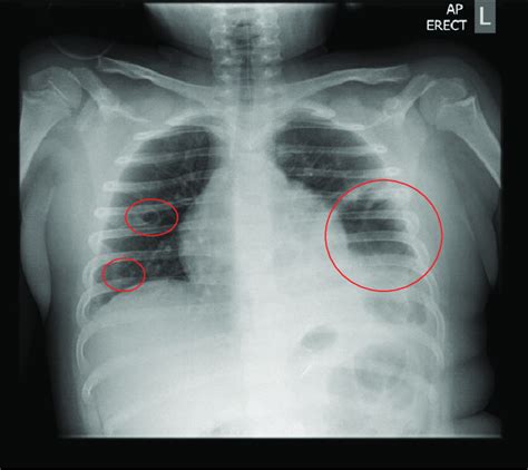 Chest Radiograph On Admission A Large Air Filled Cavity At The Left
