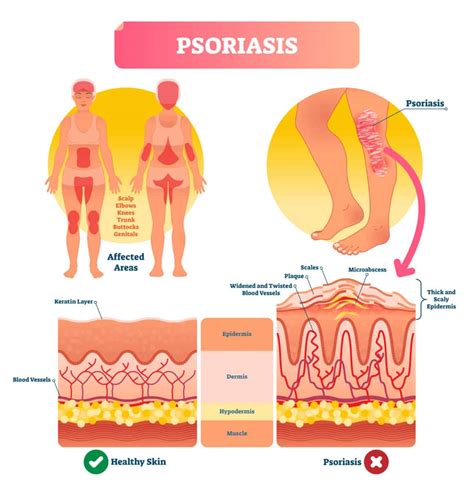 What Are The Causes Of Psoriasis Drug Genius