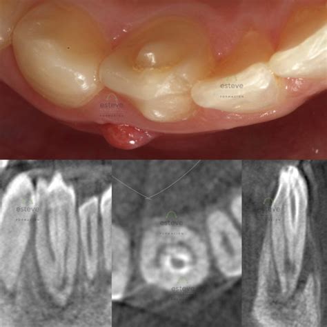 Endodoncia en dens in dente en 42 Formación Clínica Dental Esteve