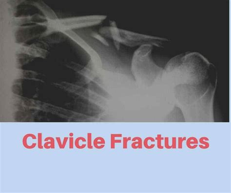 Clavicle Fracture Treatment London Shoulder And Elbow Surgeon