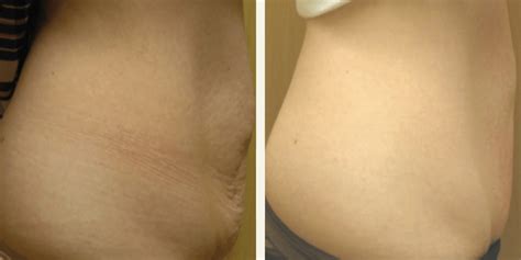 Before And After Stretch Marks Removal On Abdomen Indianapolis