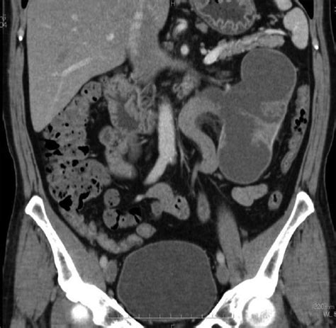 Abdominal Enhanced Computerized Tomography Scan Revealing Tumors In The